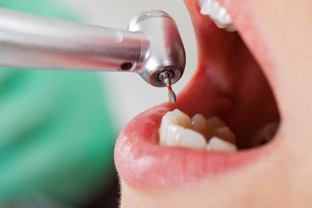 Best Emergency Root Canal Treatment in Washington, WV